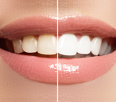 Whitening - Image